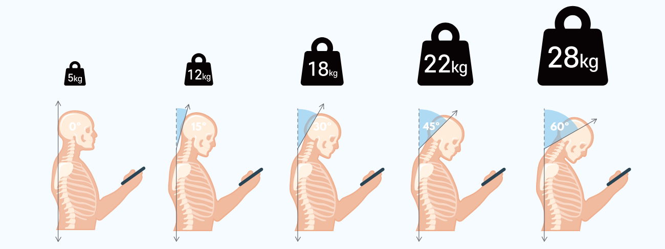 일자목(거북목) / 굽은어깨(Round shoulder)