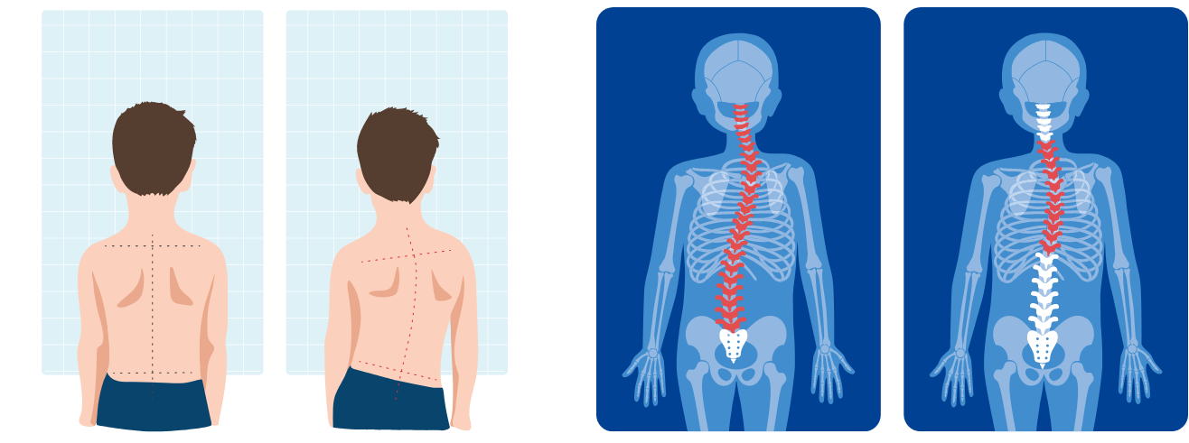 척추만곡증(Swayback) / 요추과전만(Lumbar hyperlordosis) / 일자허리(Flatback) / 척추측만증(Scoliosis)